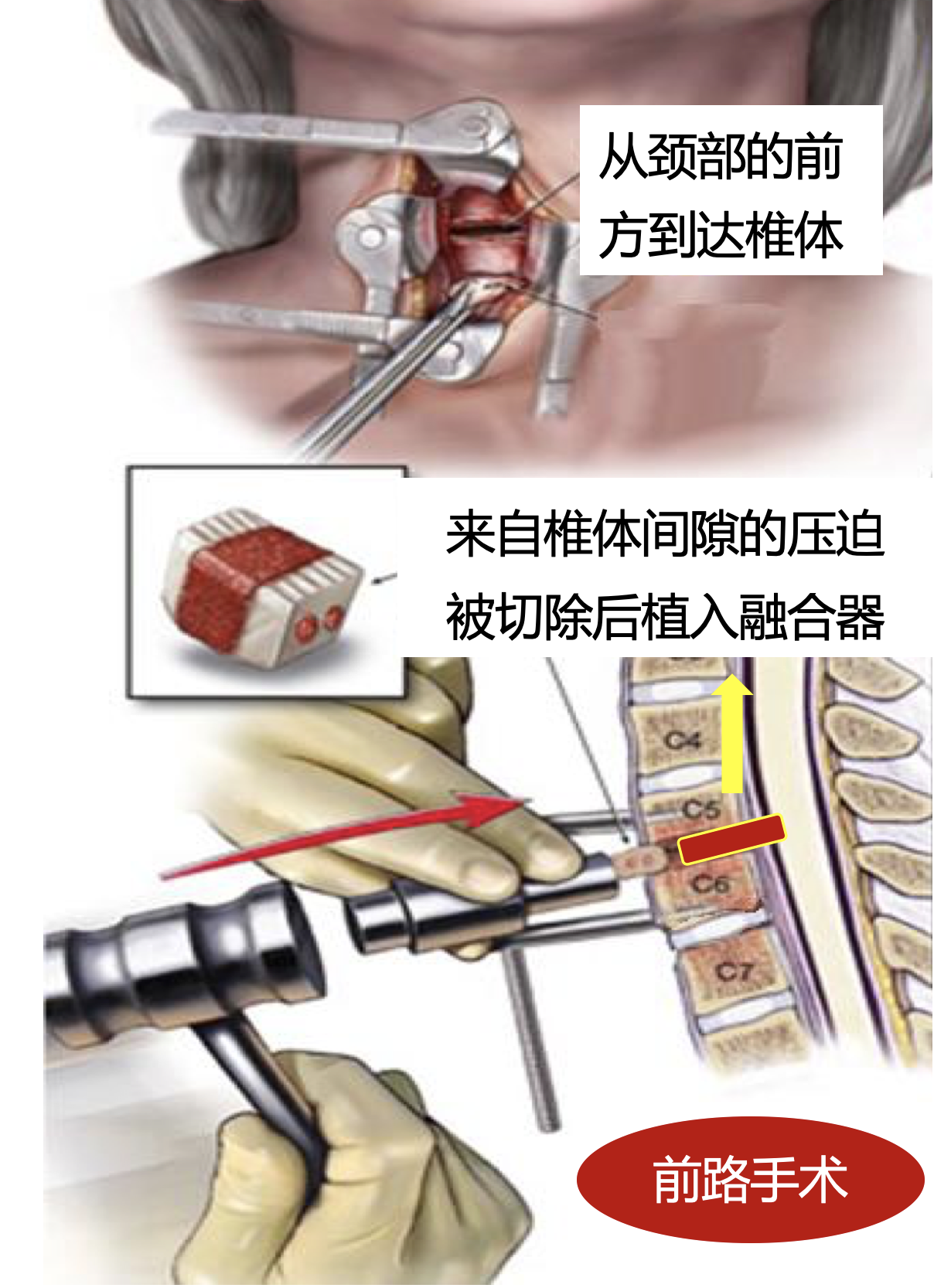 医生,听说颈椎手术可以从前面做,也可以从后面做?