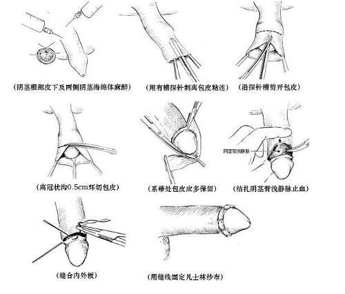 包茎手术套环流程图图片