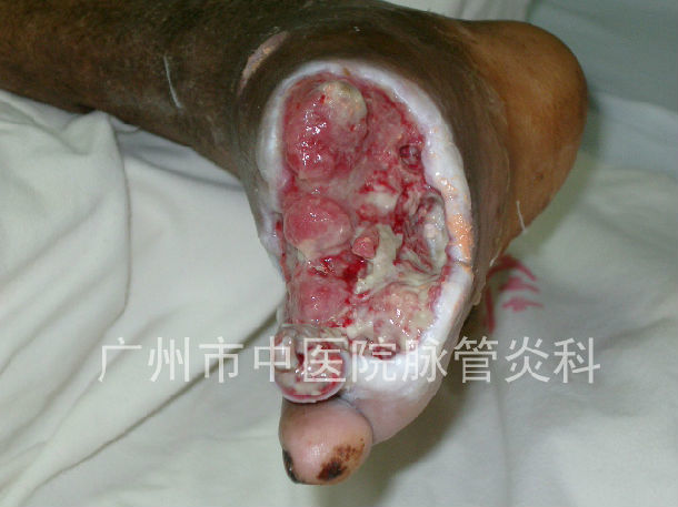原创 血栓闭塞性脉管炎的溃疡处理