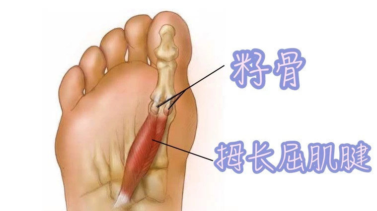 脚趾痛的罪魁祸首竟是它 籽骨炎 关节炎 关节炎 脚趾痛的罪魁祸首竟是它 籽骨炎 关节炎 关节炎
