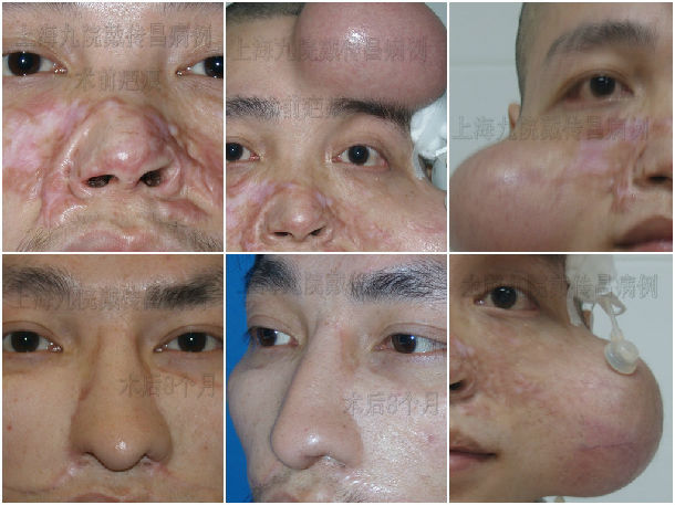 鼻缺损修复不同方法与案例 - 好大夫在线