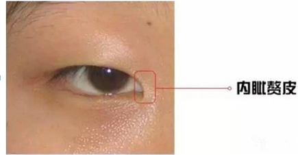 内眦赘皮 可以根据粉红色泪阜暴露程度分为多个等级,正常情况下我们的