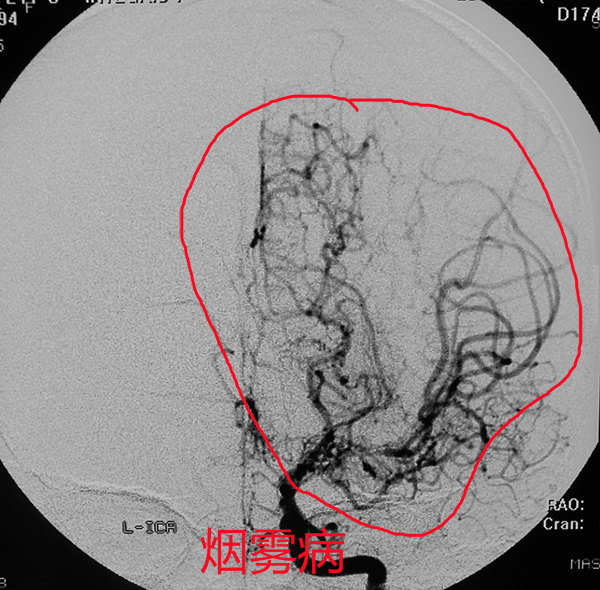 煙霧病左側翼點開顱顳淺動脈大腦中動脈搭橋