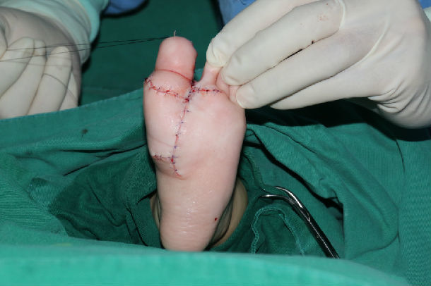 巨趾畸形的一点浅体会 - 好大夫在线