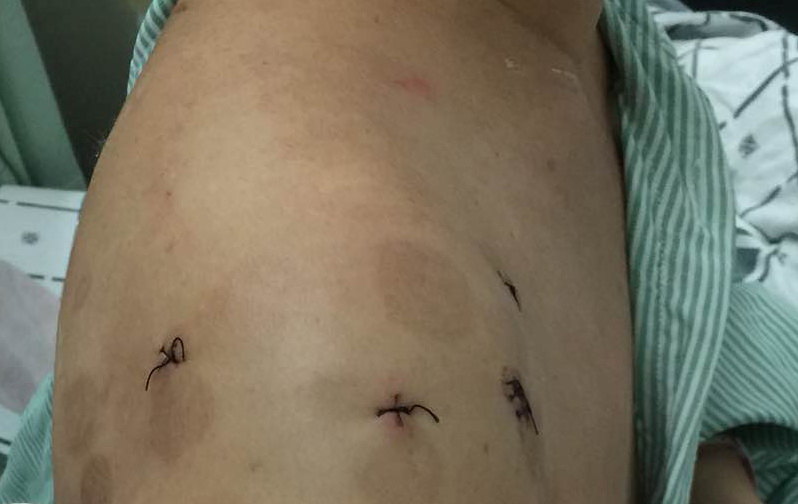 肩痛系列科普之一——肩袖钙化性肌腱炎