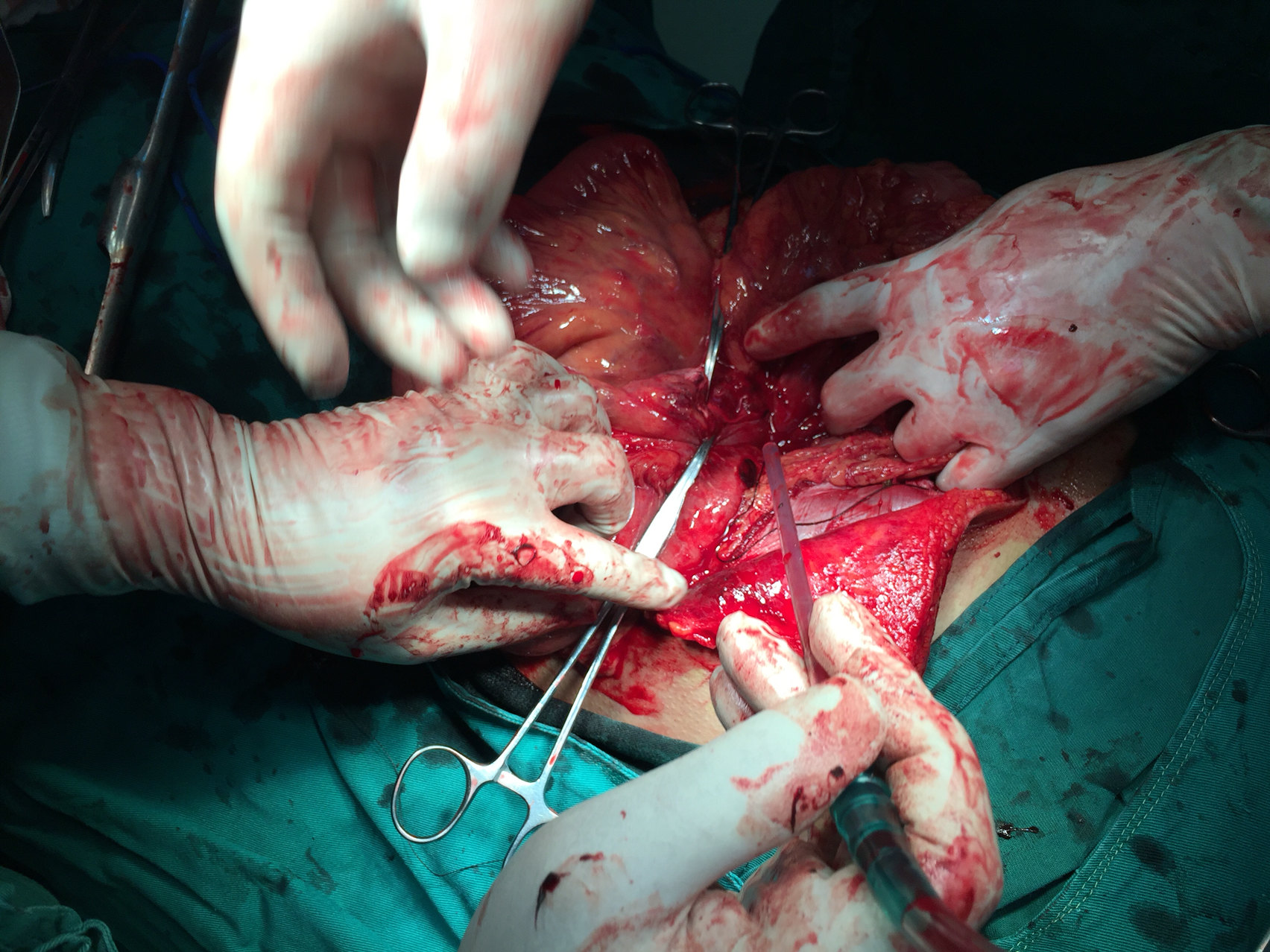 深夜救治车祸腹部损伤肠断裂