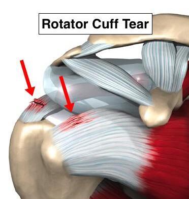 让肩膀痛和膝盖痛治疗上少走弯路