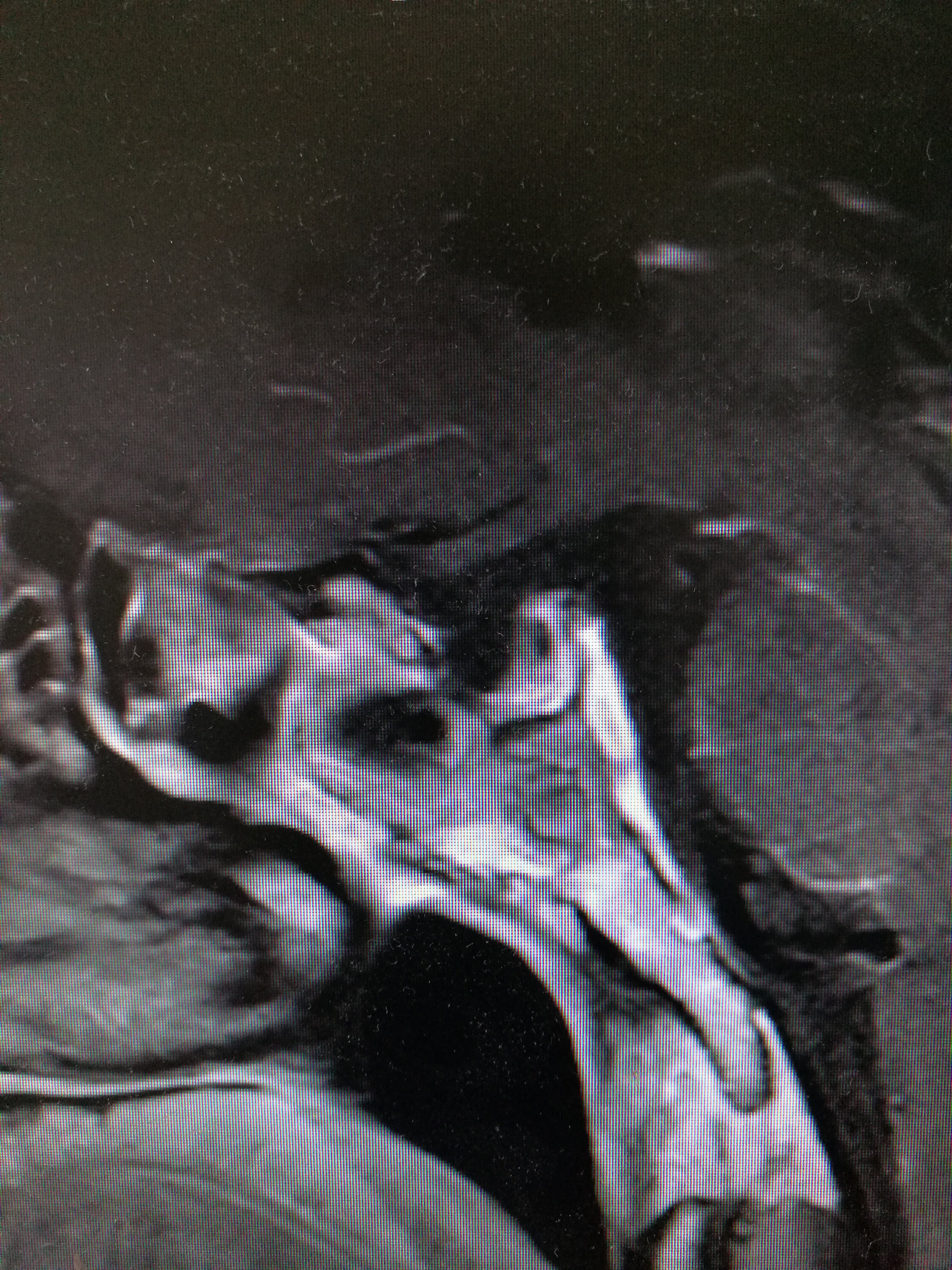 经鼻内镜下修复垂体瘤术后迟发的脑脊液鼻漏(