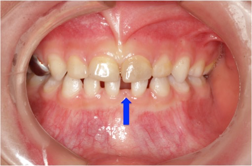 牙齿数目不足怎么办