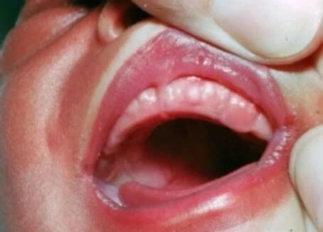 新生儿口腔上颚裂图片图片