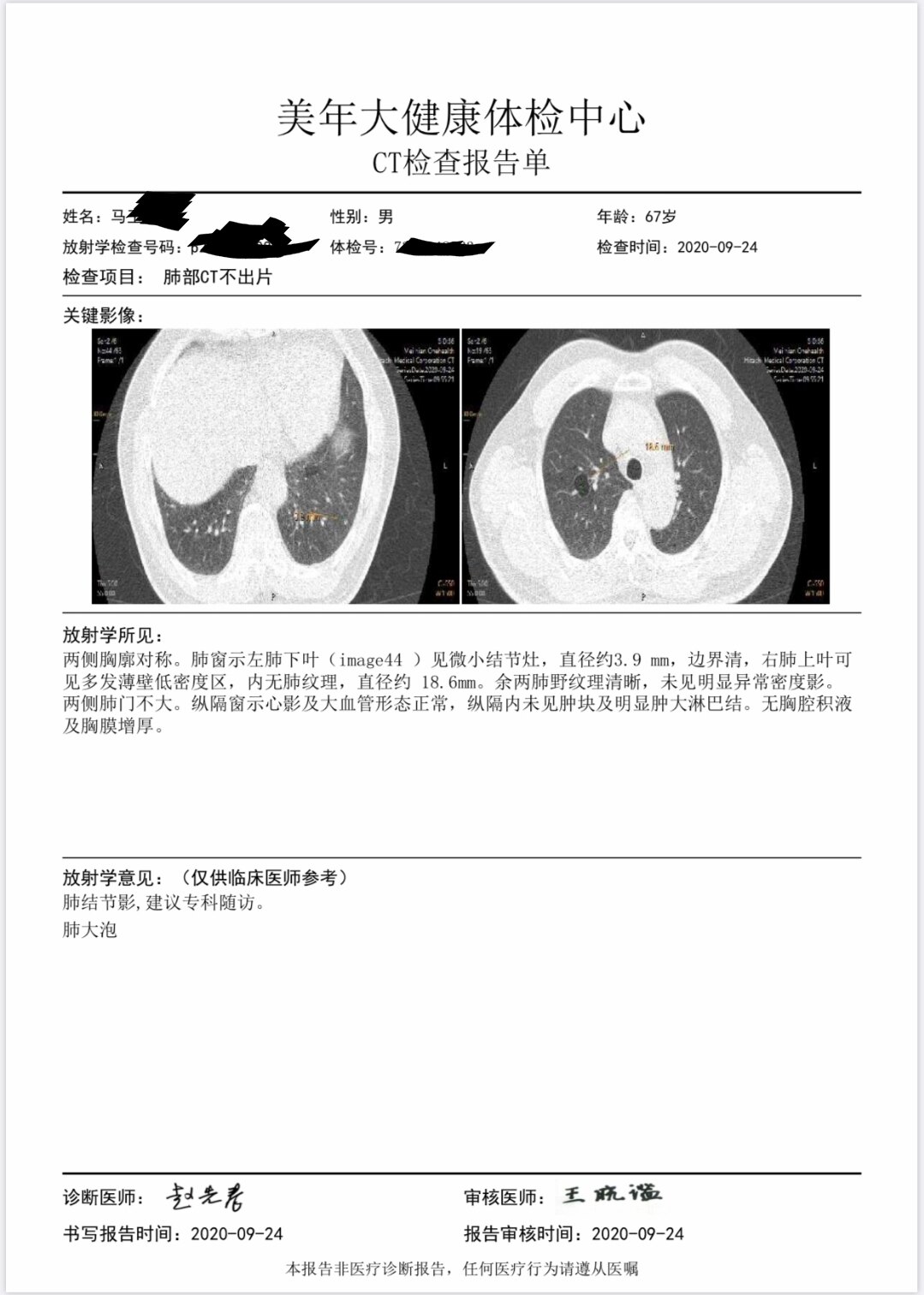 大叶性肺炎ct报告图片