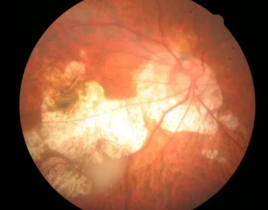 视网膜蜗牛迹样变性图片