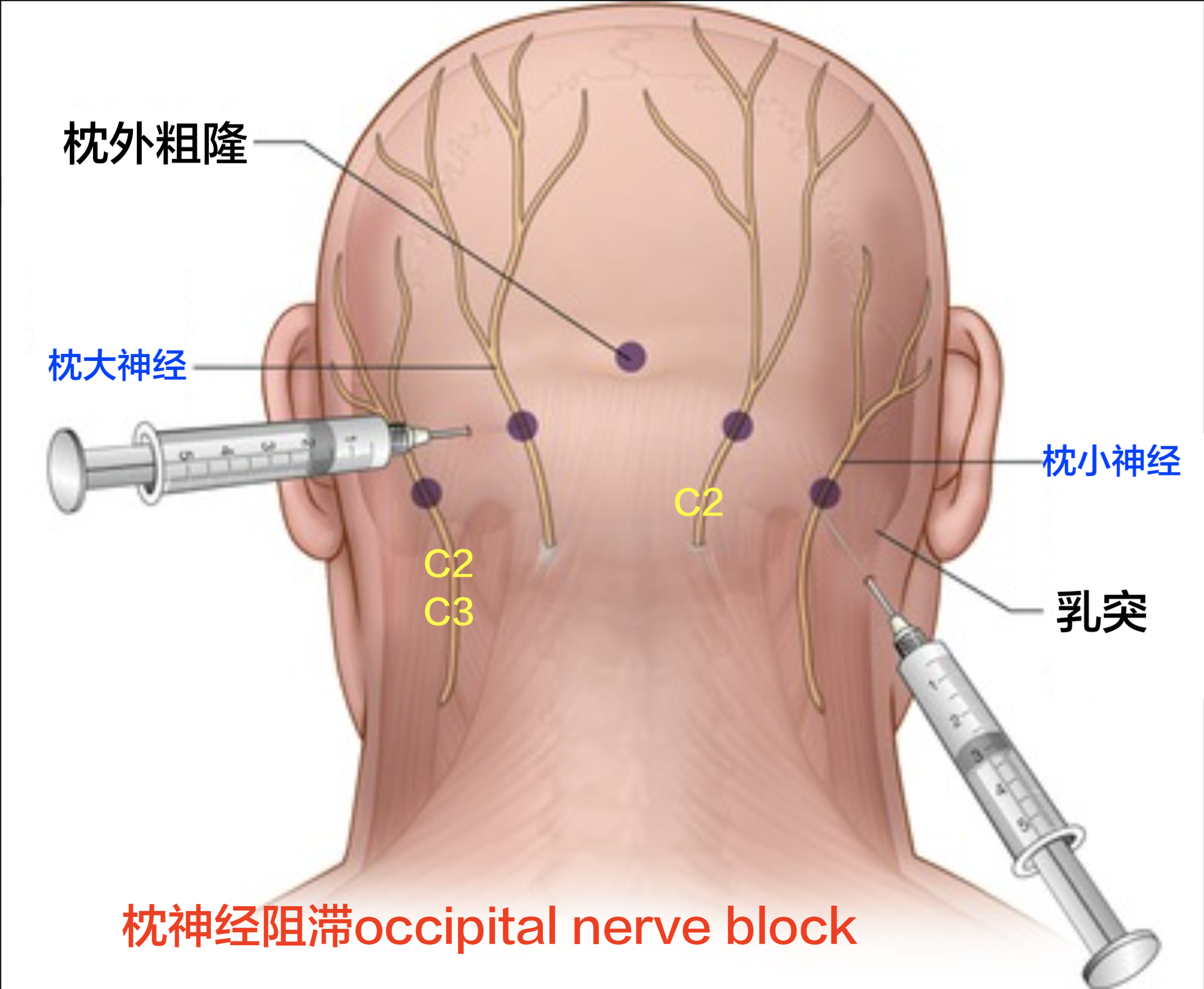 枕神经痛 神经痛 神经痛 枕神经痛 神经痛 神经痛
