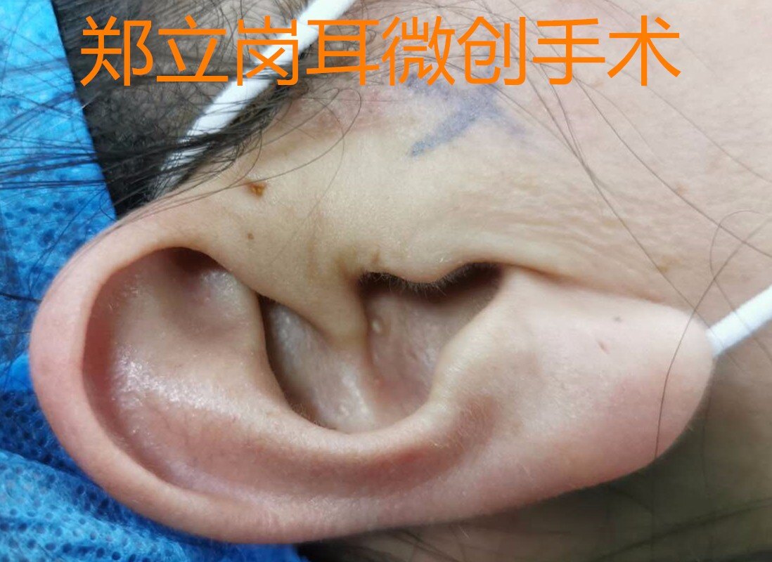 第一节 先天性耳前瘘管切除术-耳鼻咽喉头颈外科手术-医学