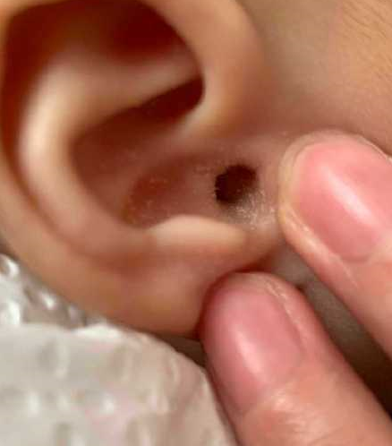 婴儿的轻微外耳湿疹