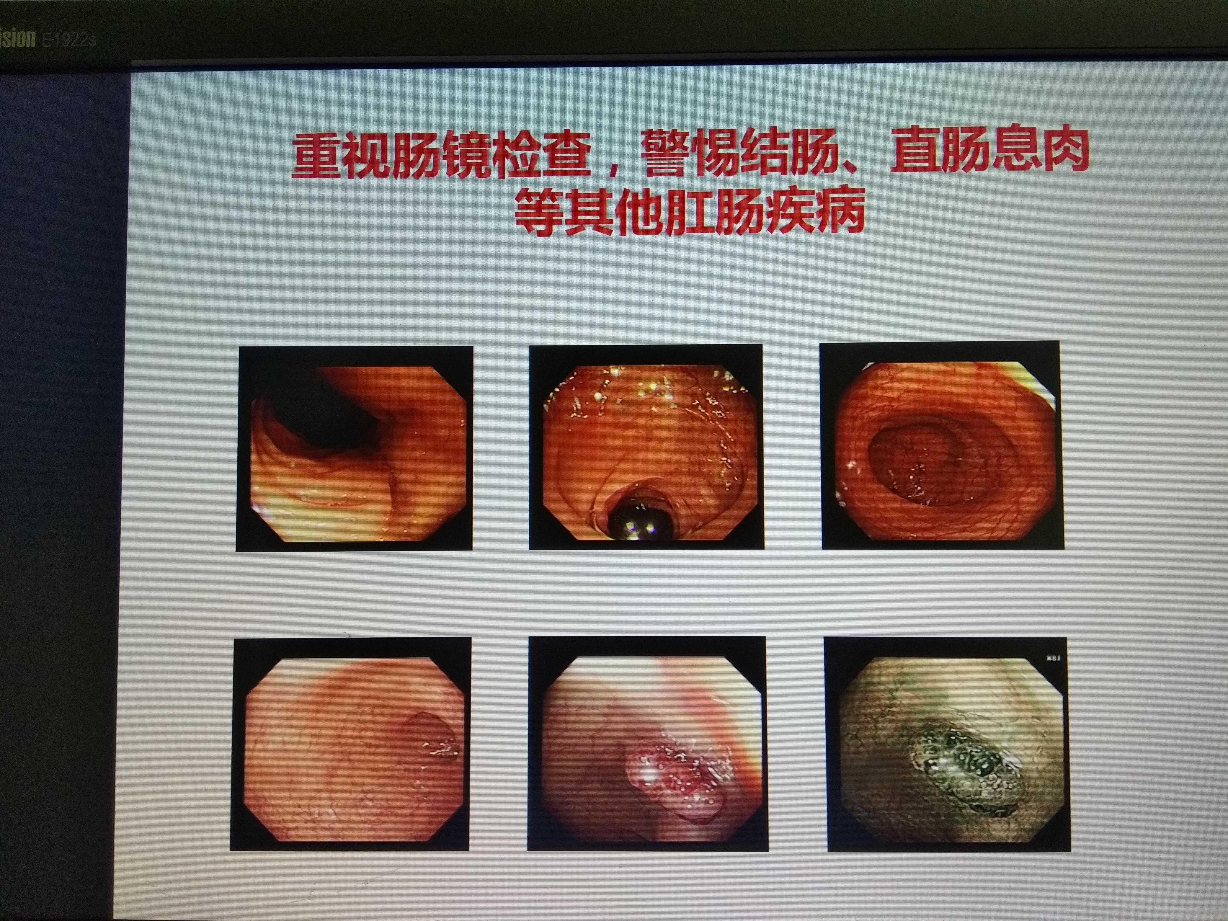 重视肠镜检查,警惕直肠癌等其他肛肠疾病!(十) - 好大夫在线