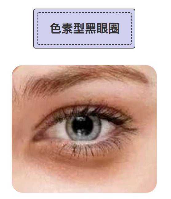 byebye黑眼圈_眼部整形_眼部整形治疗介绍 - 好大夫在线