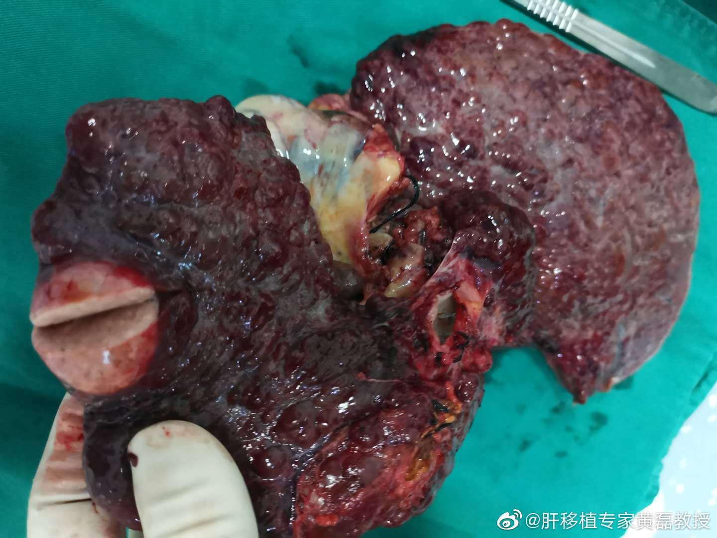 肝癌肝移植术后复发怎么办?