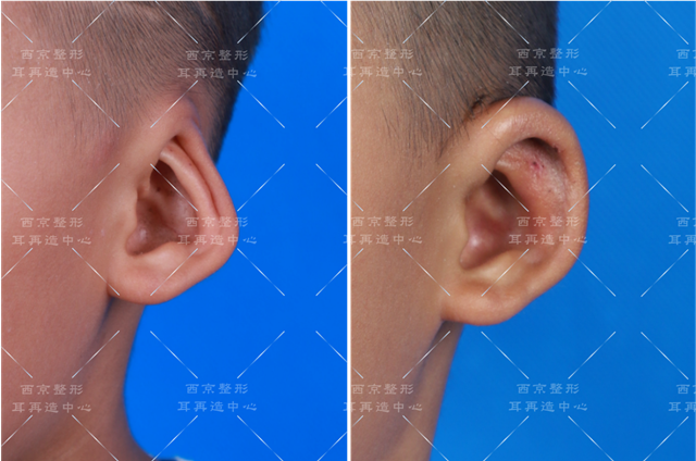 耳部整形之 隐耳