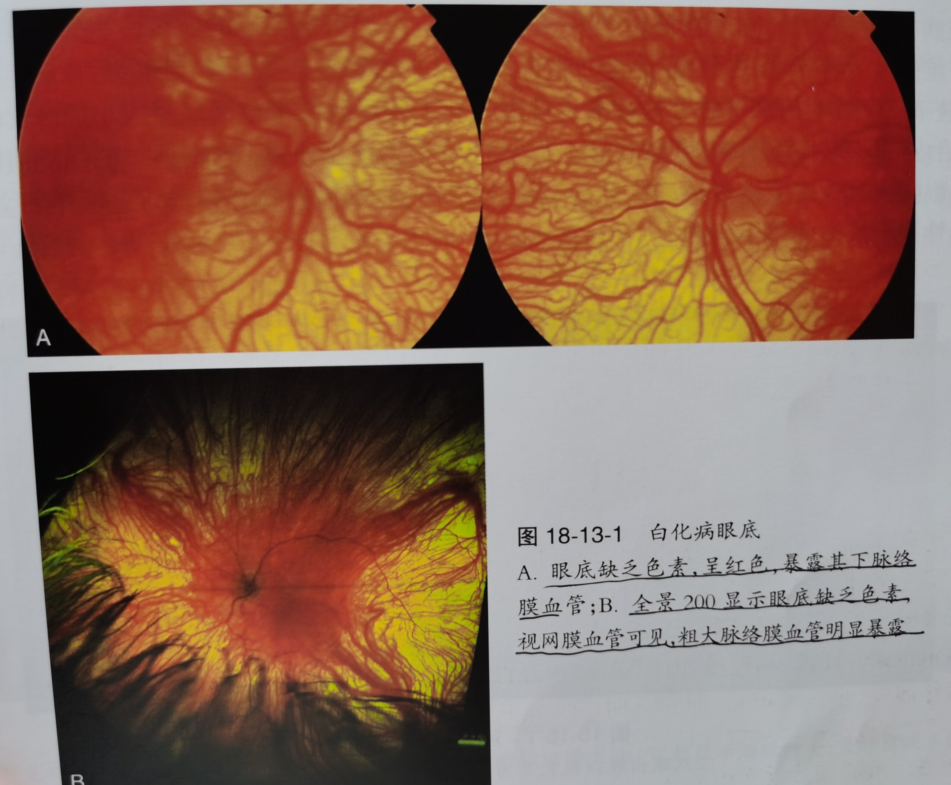 白化病_白化病症状表现 - 好大夫在线