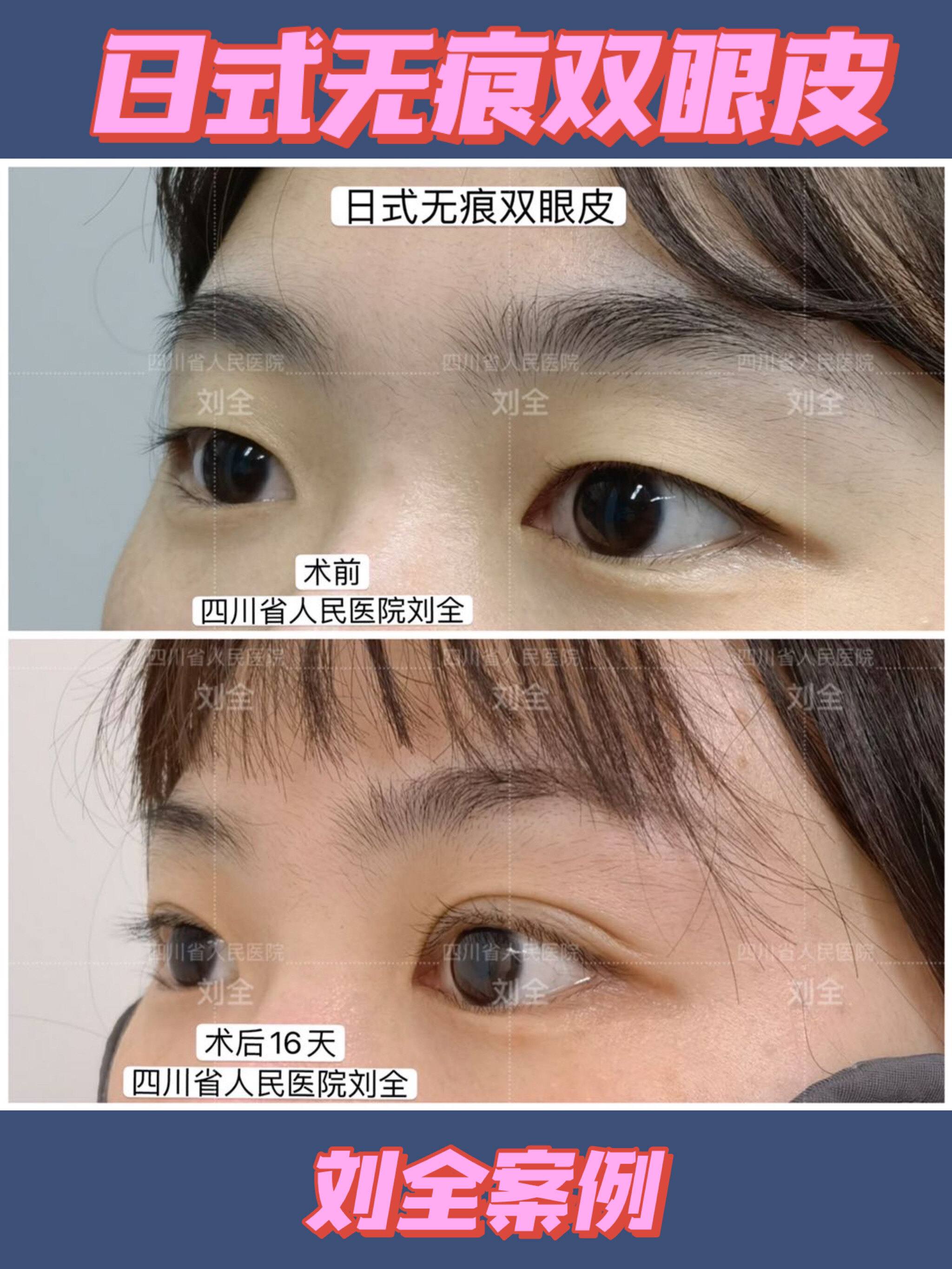 上海修复双眼皮的医生_大连双眼皮的修复_双眼皮修复价格