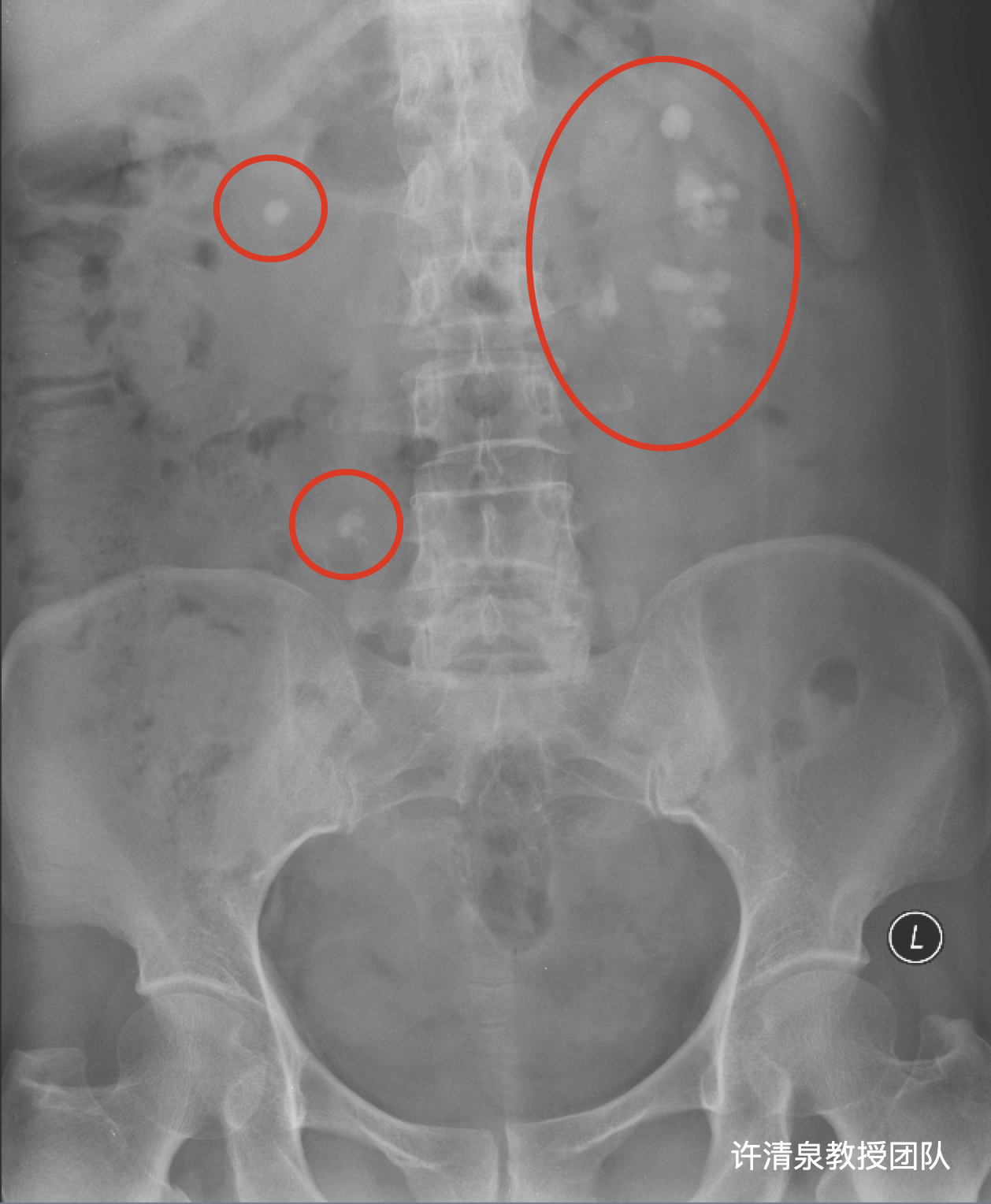 右输尿管下段结石图片图片