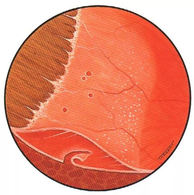 视网膜蜗牛迹样变性图片