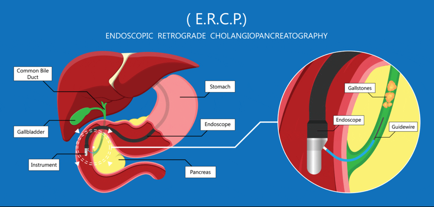 ercp手术过程图片图片