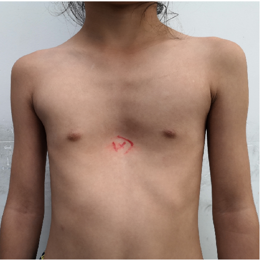 7岁女孩漏斗胸的微创手术治疗 漏斗胸 漏斗胸 7岁女孩漏斗胸的微创手术治疗 漏斗胸 漏斗胸