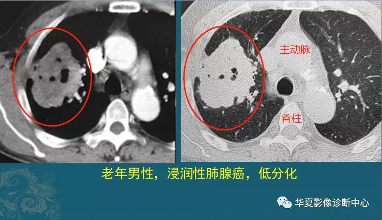 肺毛玻璃结节会不会变成肺癌 肺部结节 肺部结节