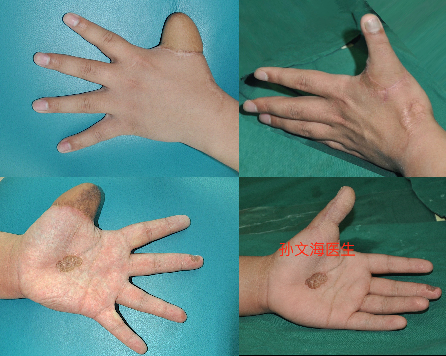 拇手指再造附案例集