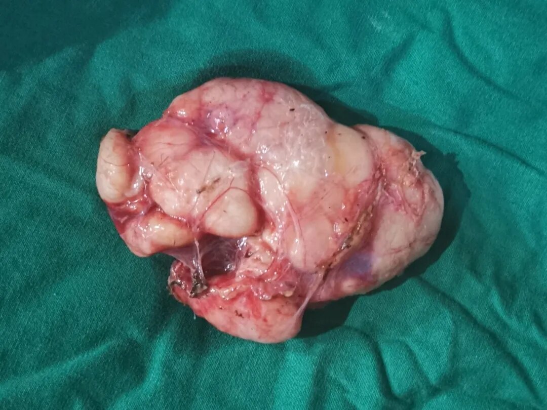 儿童腹膜后肿瘤图片