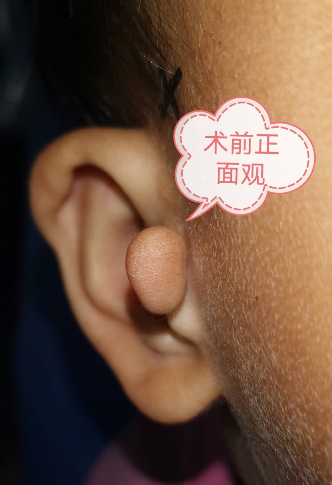 副耳"无痕"切除手术_耳部整形_耳部整形治疗介绍 - 好大夫在线