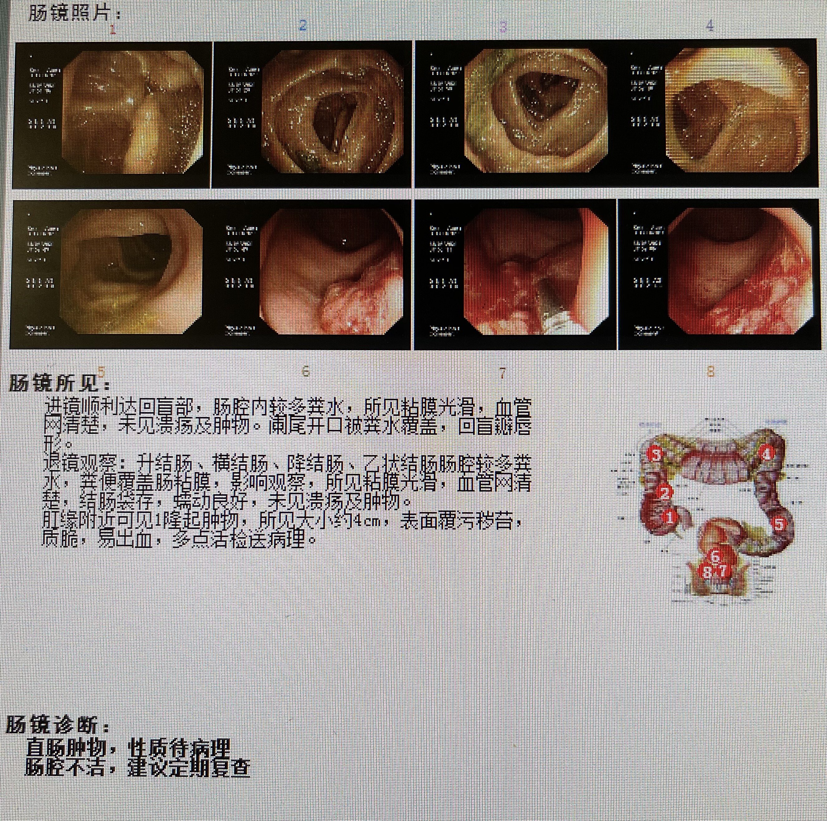 极限保肛,距离肛门3cm,又一例直肠肿瘤顺利出院! 