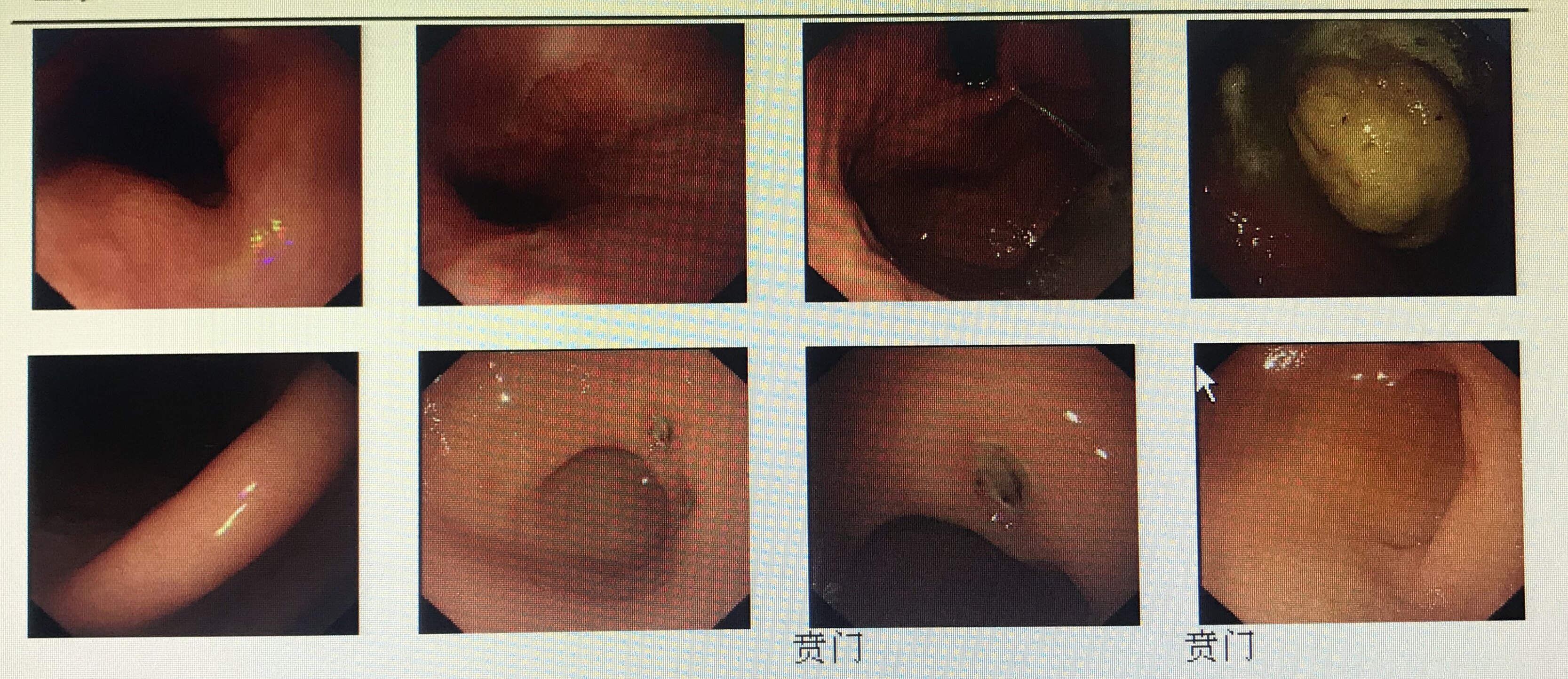 最近我遇到一个病人,胃石并导致胃溃疡.