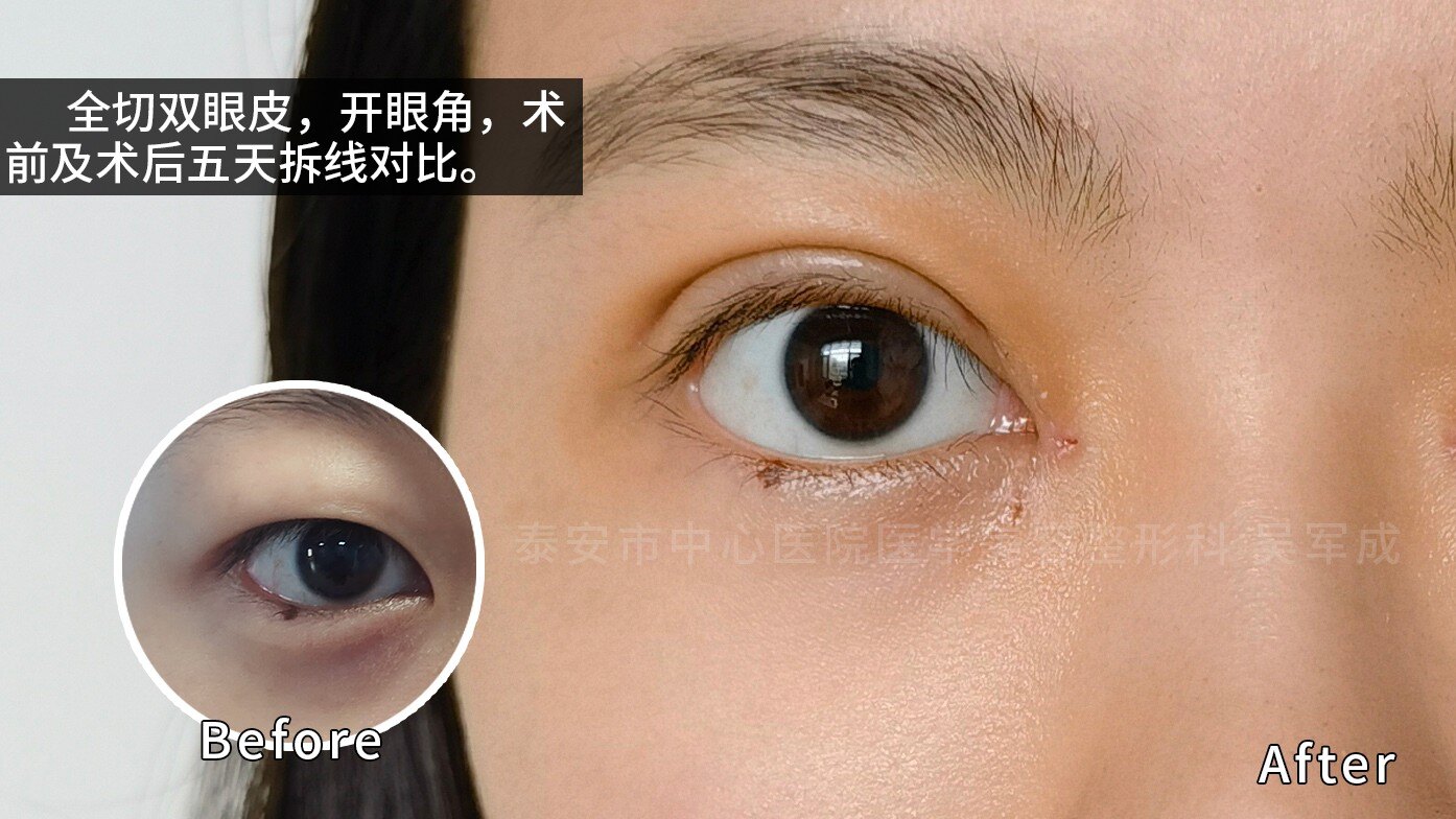 双眼皮开眼角,重睑修复多图对比照片(持续更新中)_双眼皮手术_双眼皮