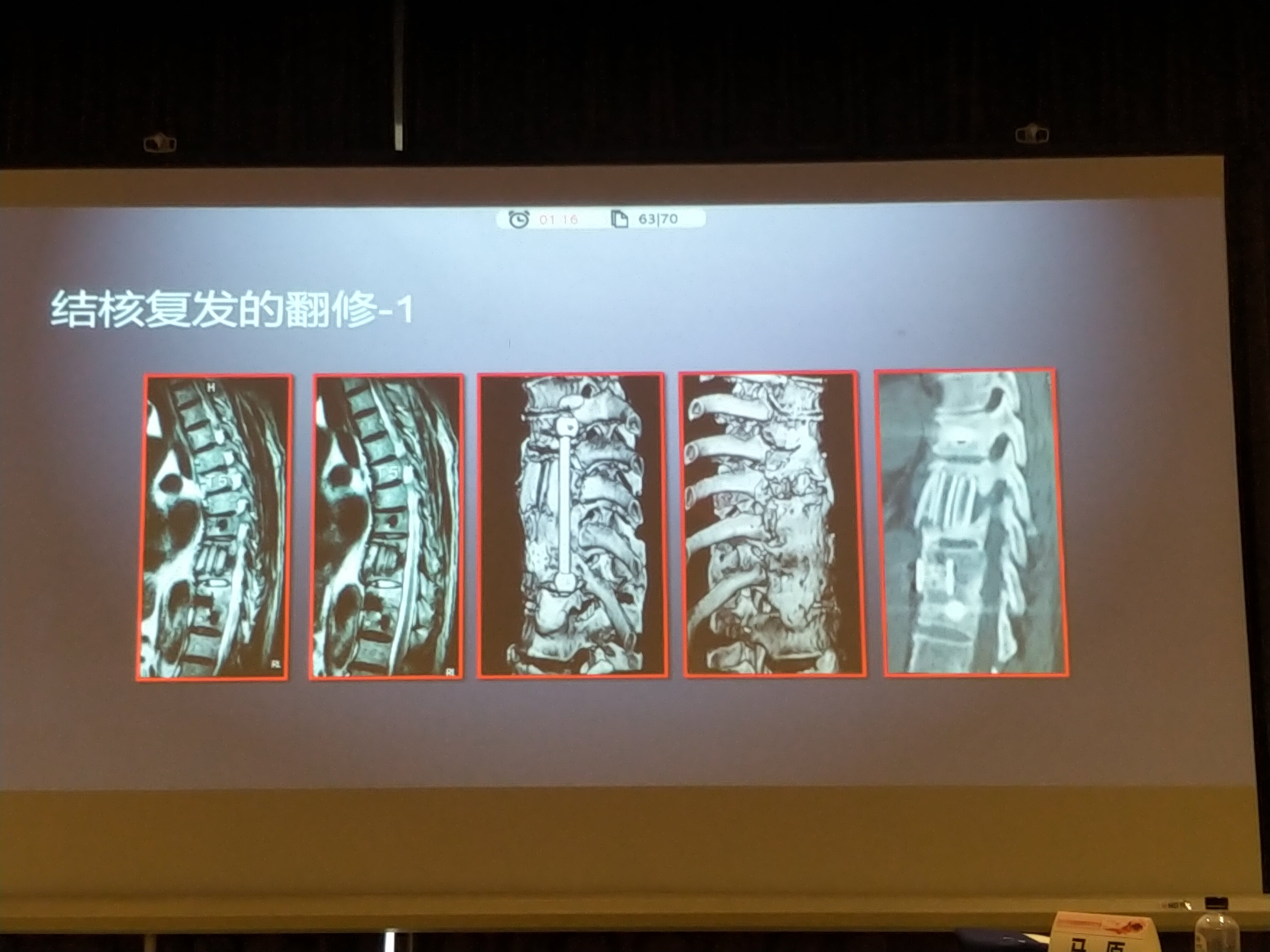 沒有脊髓神經壓迫症狀的多椎體脊柱結核我不主張做長節段固定.