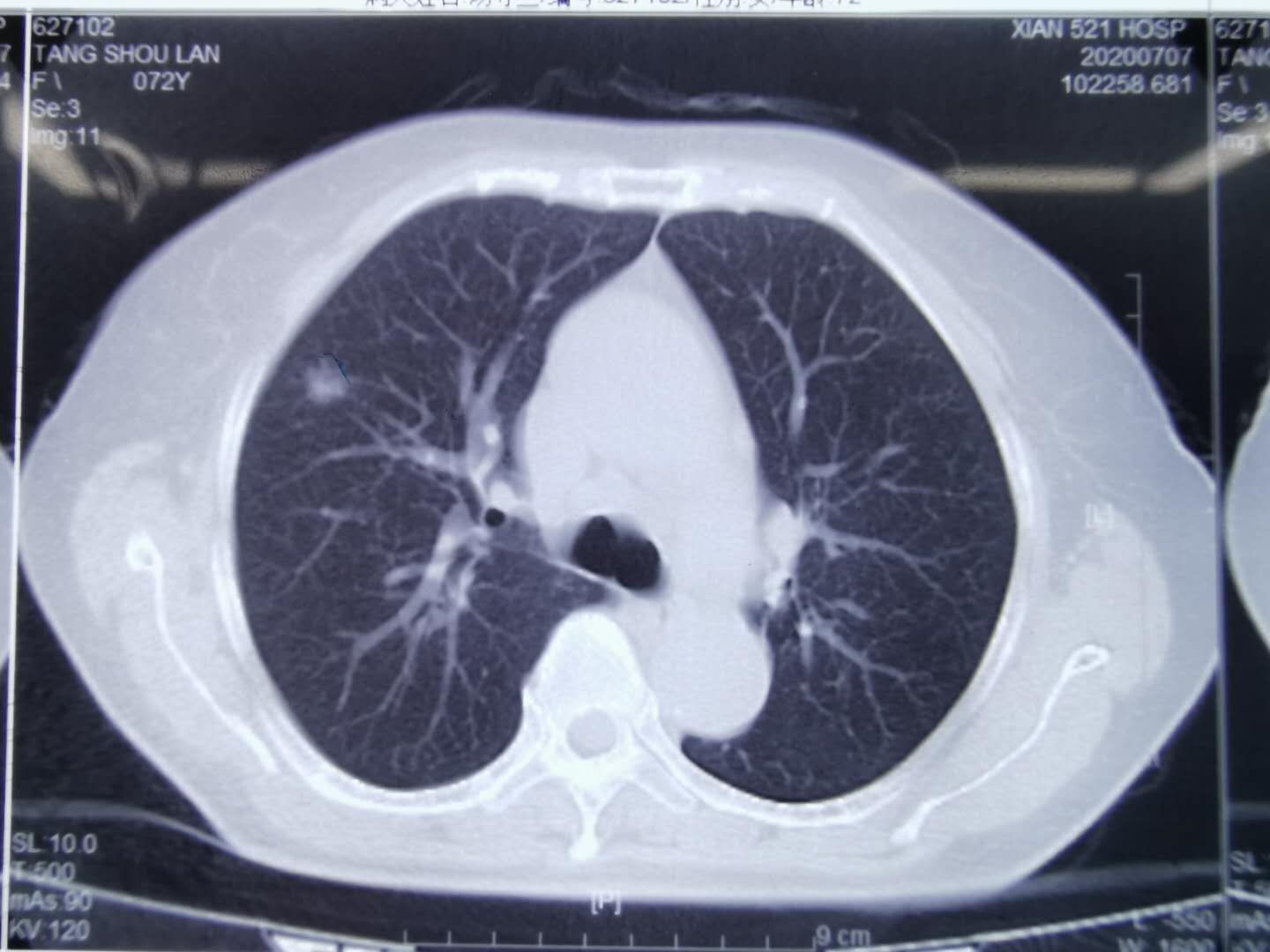 右肺上叶前段磨玻璃结节,术中冰冻病理证实为癌 - 好大夫在线