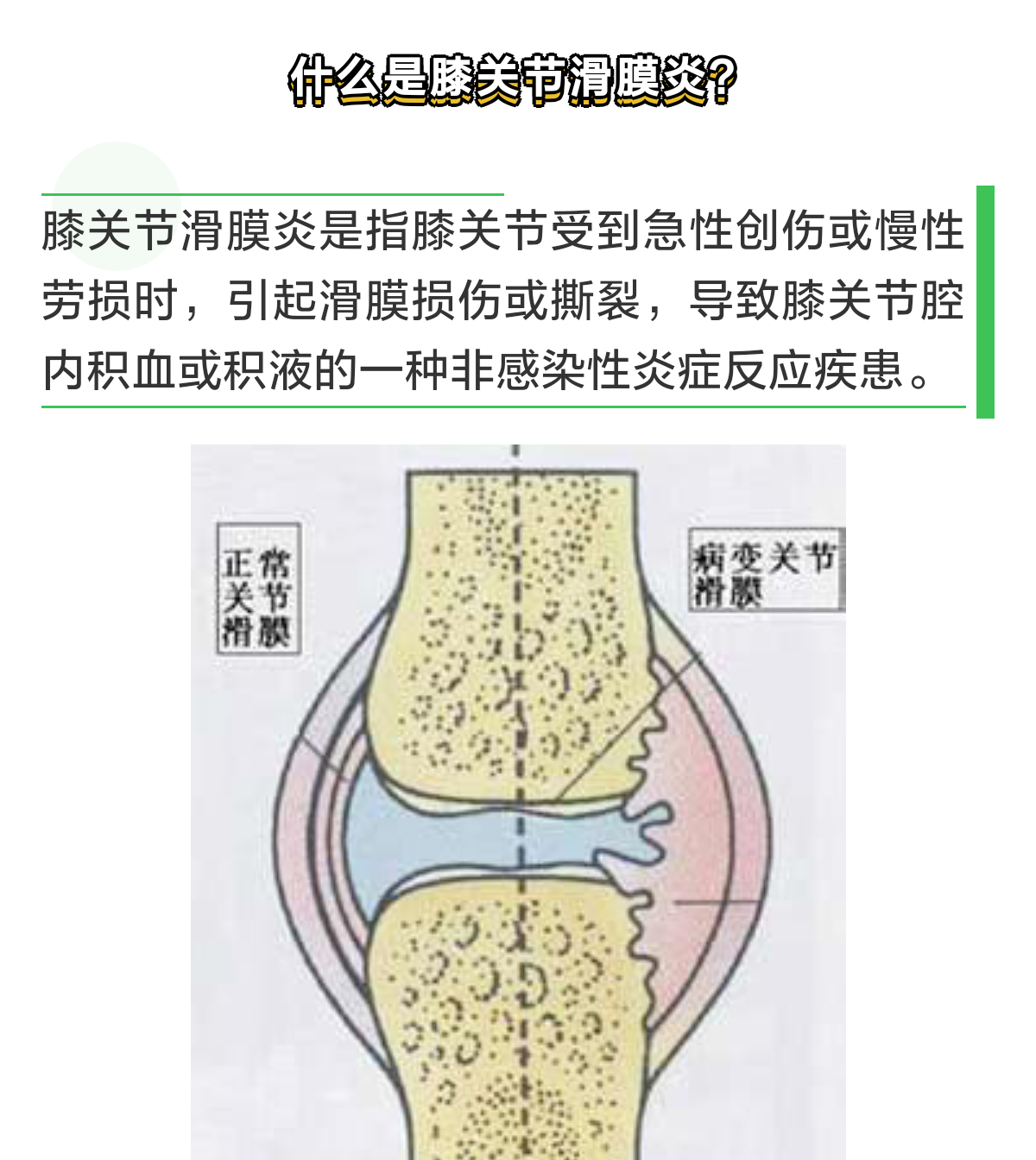 膝关节积液治疗方法图片
