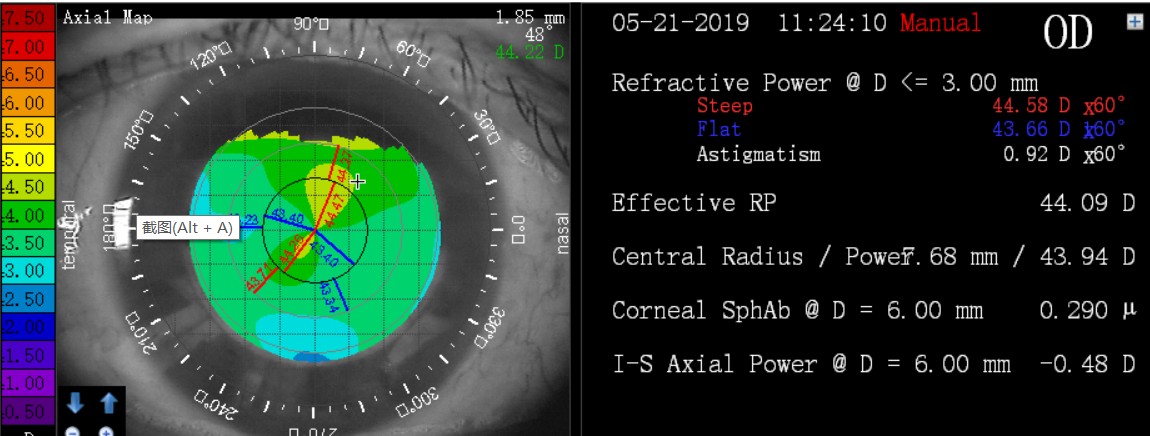 角膜地形图sai图片