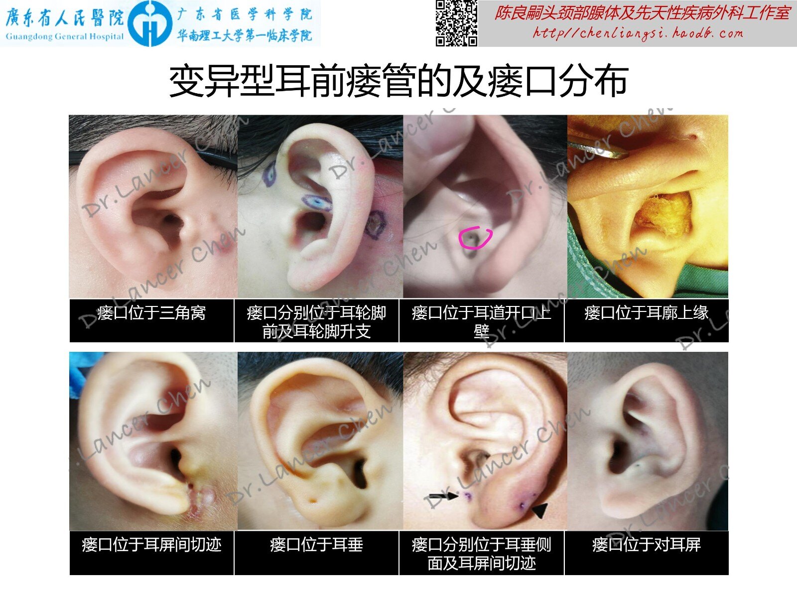 医学科普 耳前瘘管的b面 变异型 先天性耳前瘘管 先天性耳前瘘管