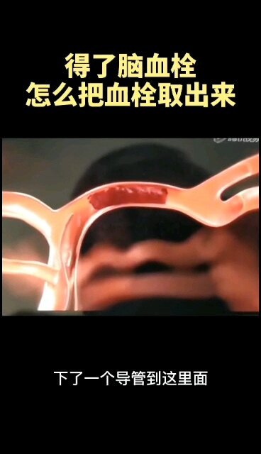 脑栓塞介入取栓治疗