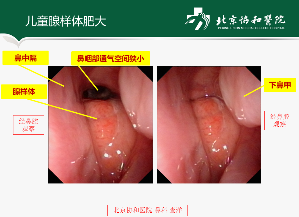 腺样体肥大111.png