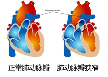 什麼是肺動脈瓣狹窄需要手術嗎