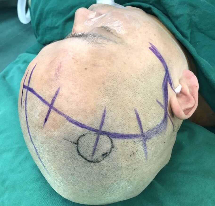 神经外科开颅手术,过去传统的做法是术前1天剃除患者所有头发