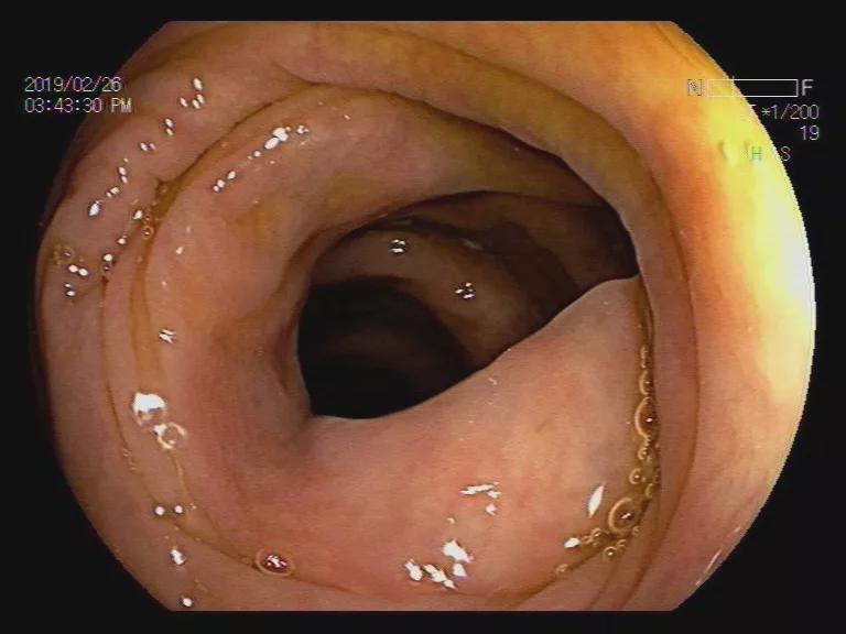 克罗恩的早期肠镜图片图片