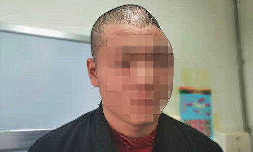 头骨凹陷怎么办?_颅骨骨折