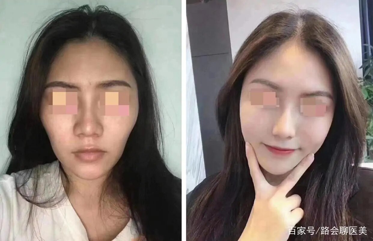 脂肪填充_脂肪填充治疗介绍 - 好大夫在线