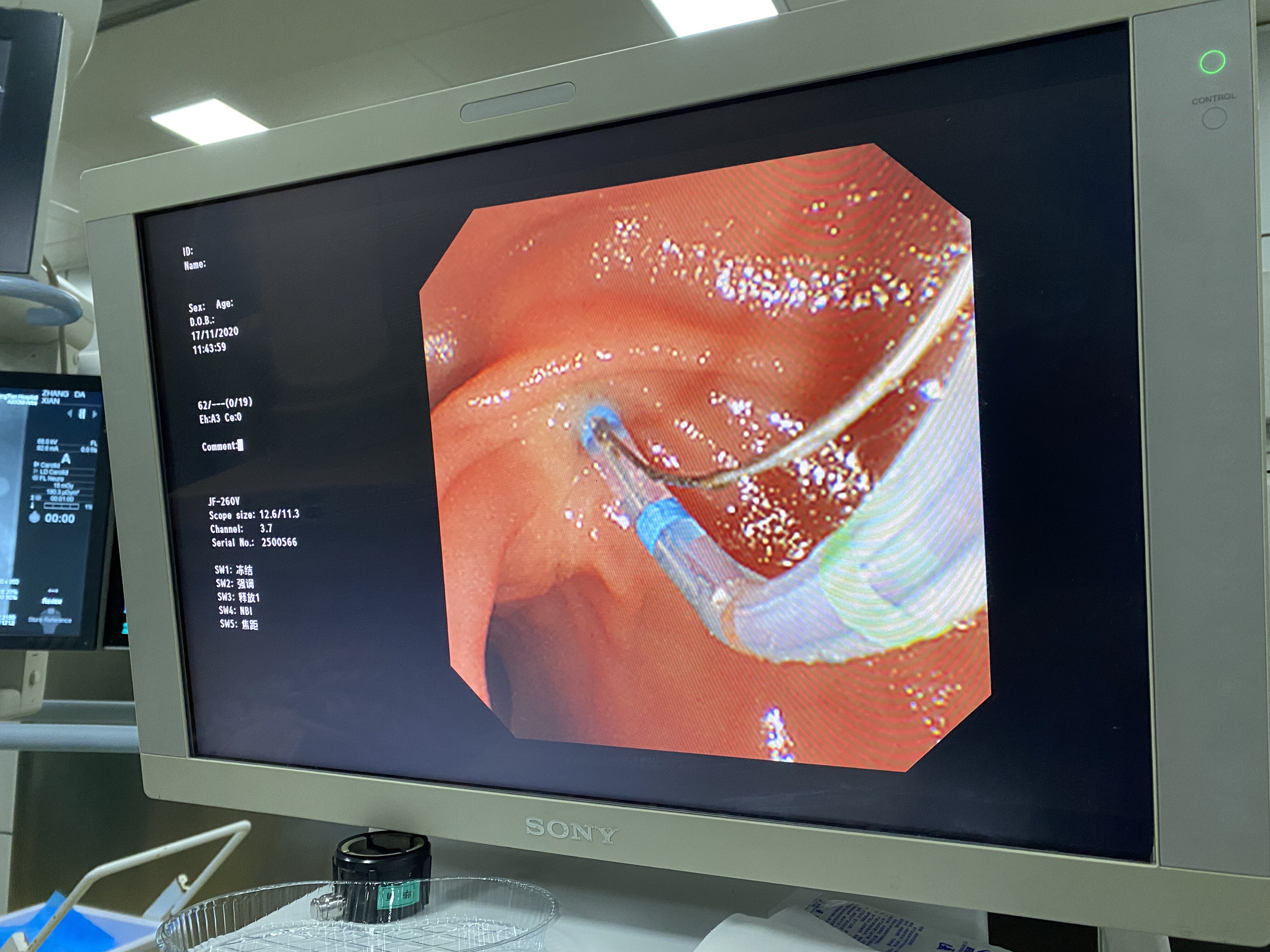 ercp手术过程图片图片