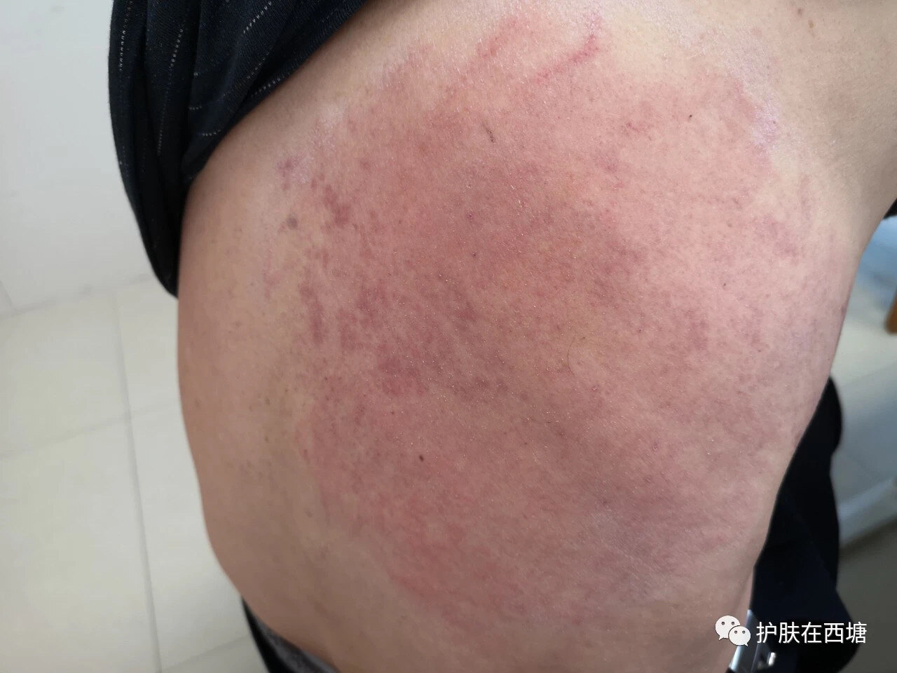 过敏是免疫力差所致?天大的误会还真不少!_过敏 - 好大夫在线